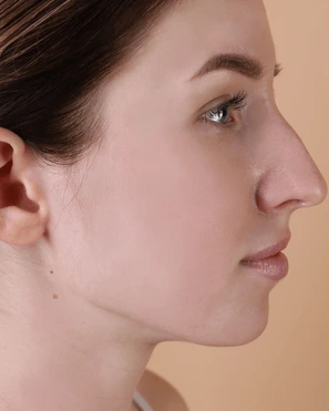 Before Acne Treatment